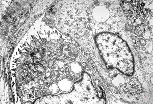 F,38y. | ovary - adenocarcinoma